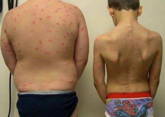 Éruptions cutanées sur la peau avec des vers