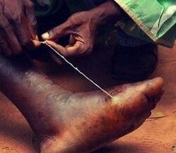 Parasite dans le pied d'une personne
